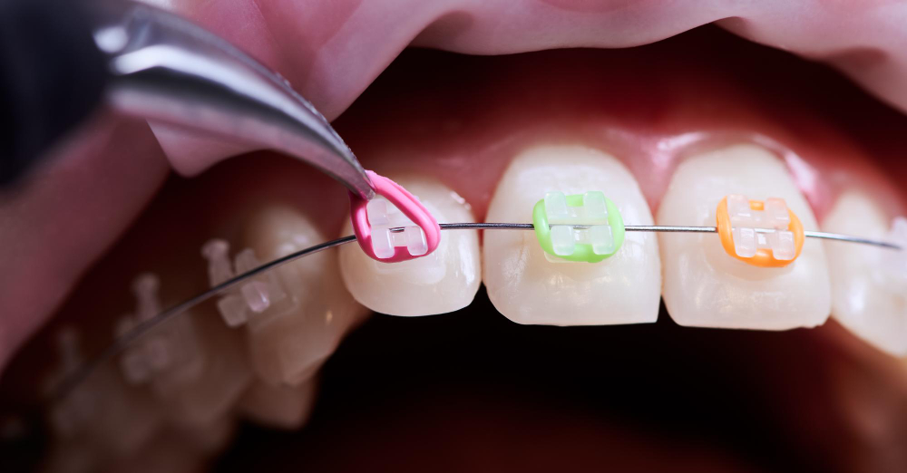 Elastic Rubber Bands dental-8webz.com
